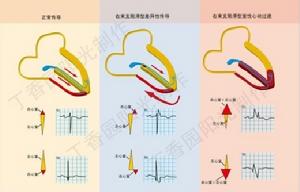 左束支傳導阻滯