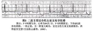 左束支傳導阻滯