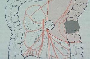 大腸次全切除術