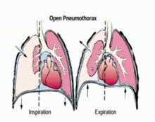 開放性氣胸