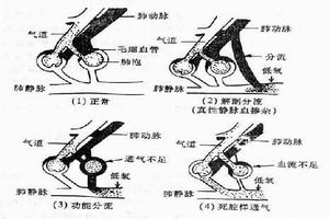 慢性呼吸衰竭