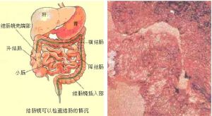 結腸息肉症