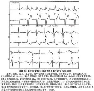 雙側束支傳導阻滯