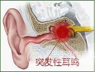 搏動性耳鳴