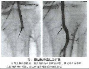 《急性周圍動脈栓塞手術》