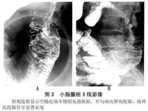 （圖）小腸腺癌