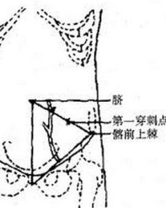 腹腔穿刺術