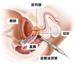 精索靜脈高位結紮術