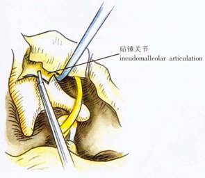 腸易激綜合症