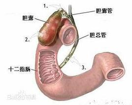 順行式膽囊切除術