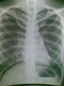 肺部鈣化