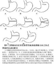 圖4 門脈高壓症