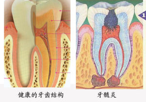 急性牙髓炎