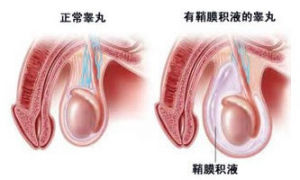 睪丸膜積液