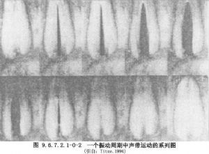 甲狀軟骨板成形術