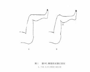 （圖）後十字韌帶損傷