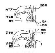 不可復性盤前移位