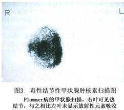 毒性結節性甲狀腺腫