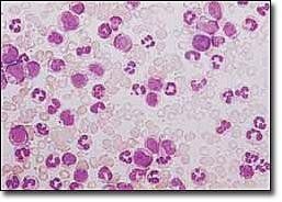 成人型慢性粒細胞白血病