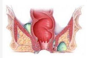 肛門直腸周圍膿腫