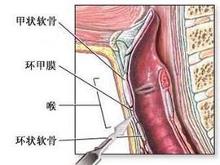 先天性喉裂