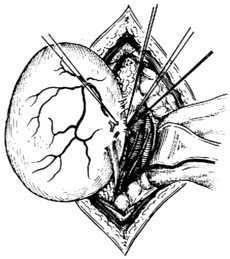 原發性腹膜後腫瘤