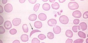 鐮狀細胞性貧血