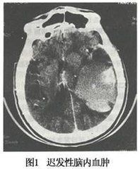 遲發性外傷性腦內血腫