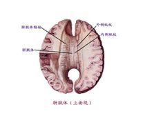 胼胝體