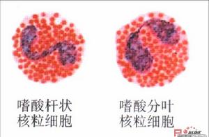 特發性嗜酸性粒細胞增多綜合症