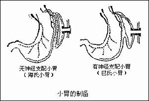 胃泌素瘤