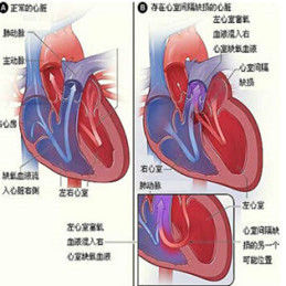 心室間隔缺損