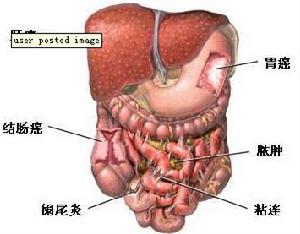 迴腸遠端憩室