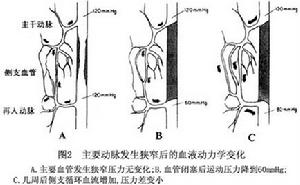 下肢動脈硬化閉塞症