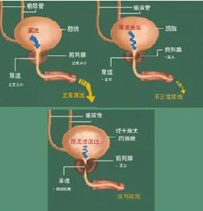 （圖）前列腺肉瘤