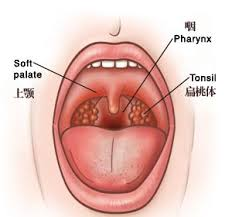 扁桃體結石