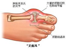 痛風偏方