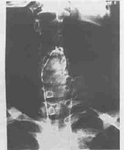 妊娠合併甲狀腺功能減退