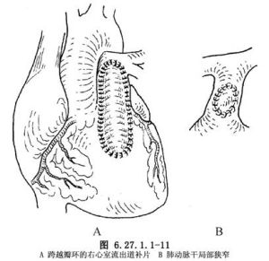 法樂氏四聯症