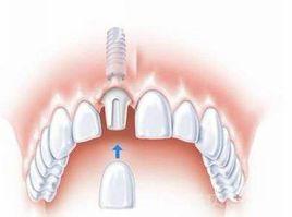 單顆種植牙齒
