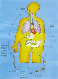 肝多房棘球絛蟲感染