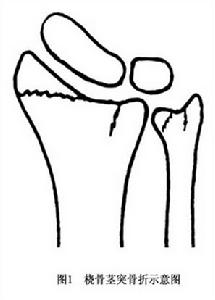 橈骨莖突骨折示意圖