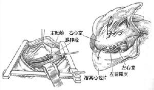 放射性心包炎