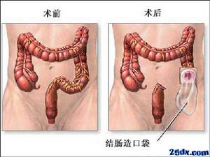 《結腸造口術》