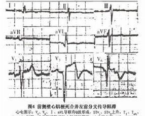 左前分支傳導阻滯