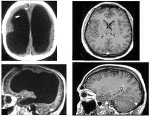 急性壞死出血性腦脊髓炎