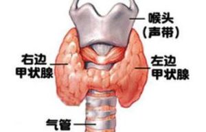 甲亢病