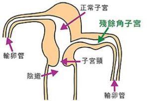 子宮畸形