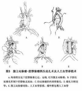 腹主動脈腔靜脈瘺