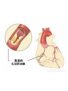 心肌缺血